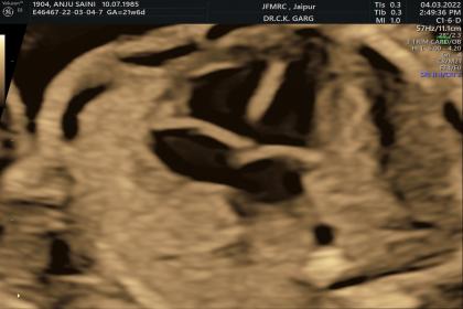 Fetal Echo