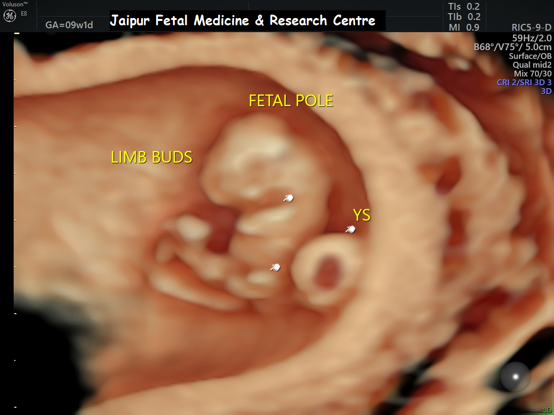 Multifetal Pregnancy Reduction