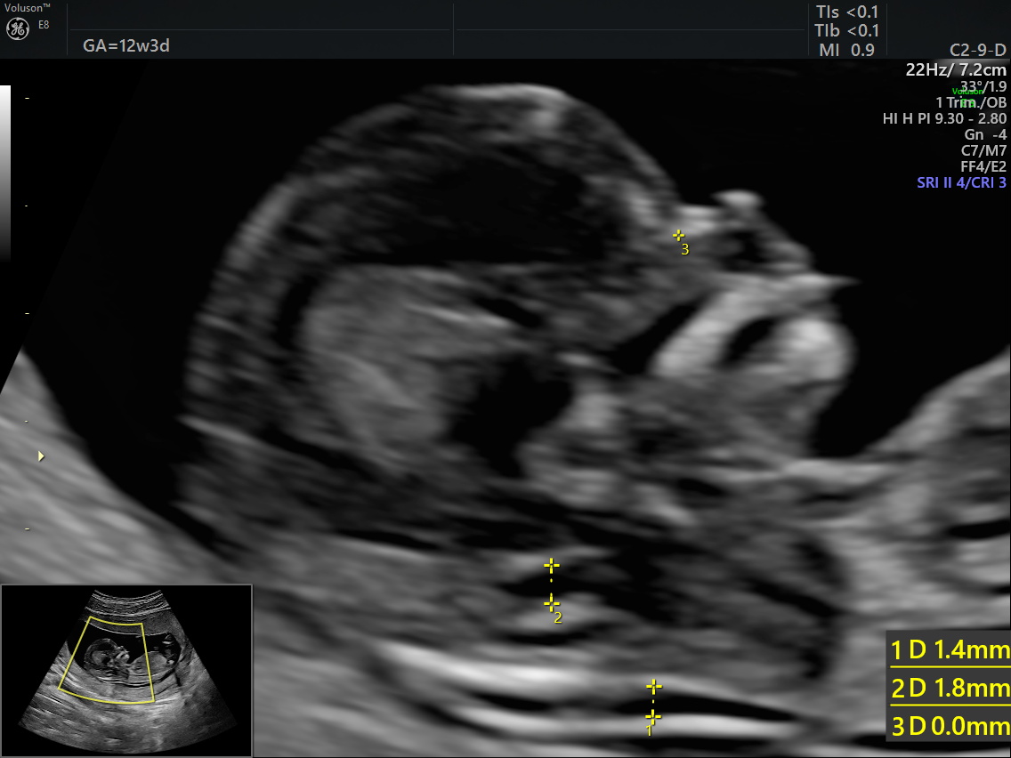 Prenatal screening
