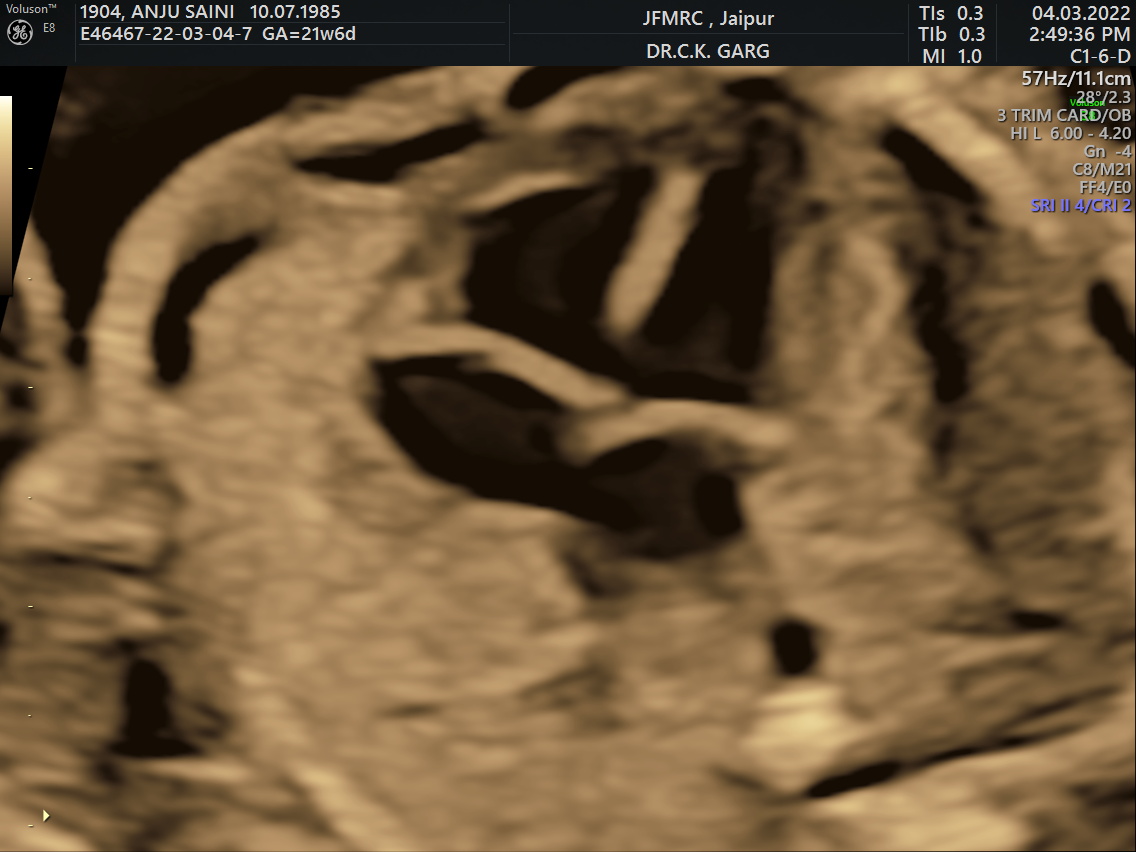 Fetal Echo