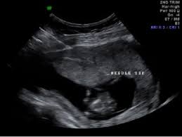 Chorionic villus sampling